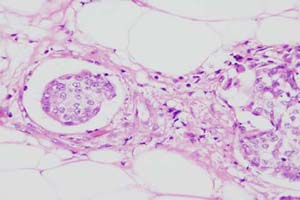 This focus was regarded as NOT being diagnostic of lymphatic invasion but more likely to be simply retraction artefact of surrounding tissues